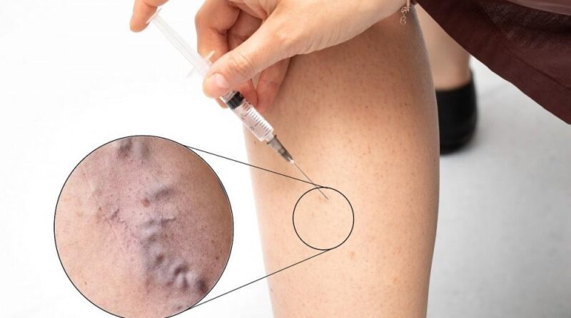 What is Sclerotherapy
