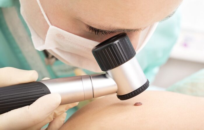 Dermatologists Treat Skin Cancer