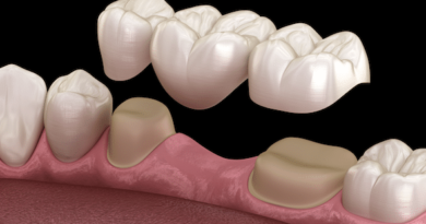 Smile With Dental Crowns And Bridges