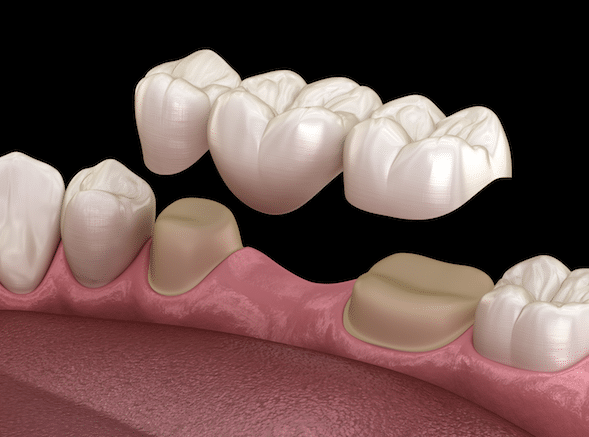 Smile With Dental Crowns And Bridges
