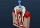 Understanding Root Canal Therapy And When It’s Needed