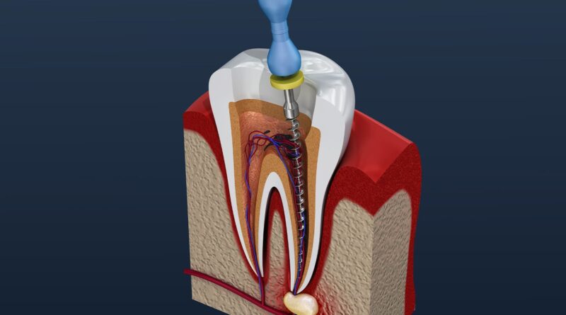Understanding Root Canal Therapy And When It’s Needed