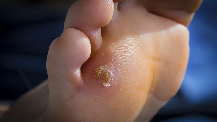 Common Foot Conditions Treated By A Podiatrist