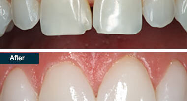 Repair Chipped Teeth