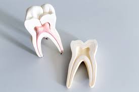 Root Canal Treatment