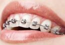 Braces Treatment