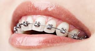 Braces Treatment