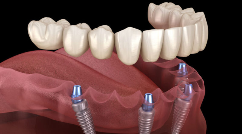 Tooth Replacement