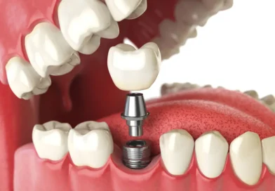 Prosthetic Dentistry