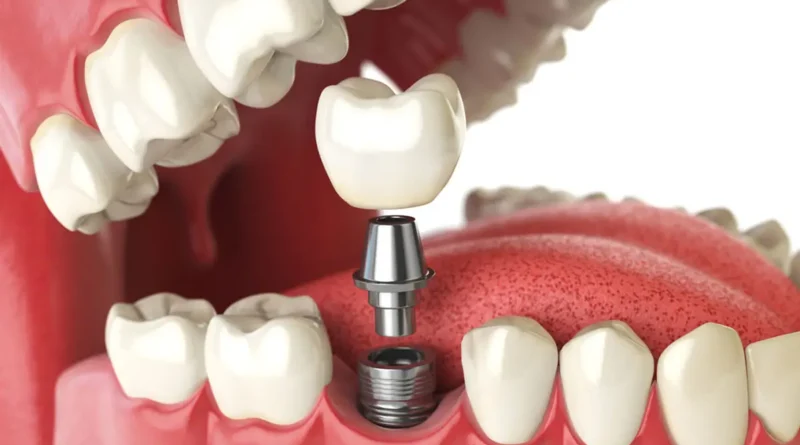 Prosthetic Dentistry